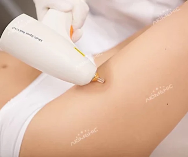 Кращий метод для видалення судин — відповідь лікаря