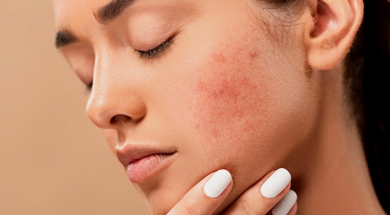 Коли шкіра подає сигнал тривоги: що приховують виразки та гнійники