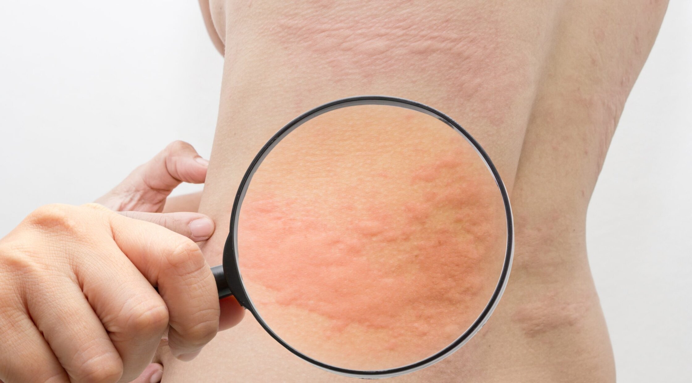 Чи Може Алергія Пройти Сама: Причини, Симптоми та Лікування у 2025 Році