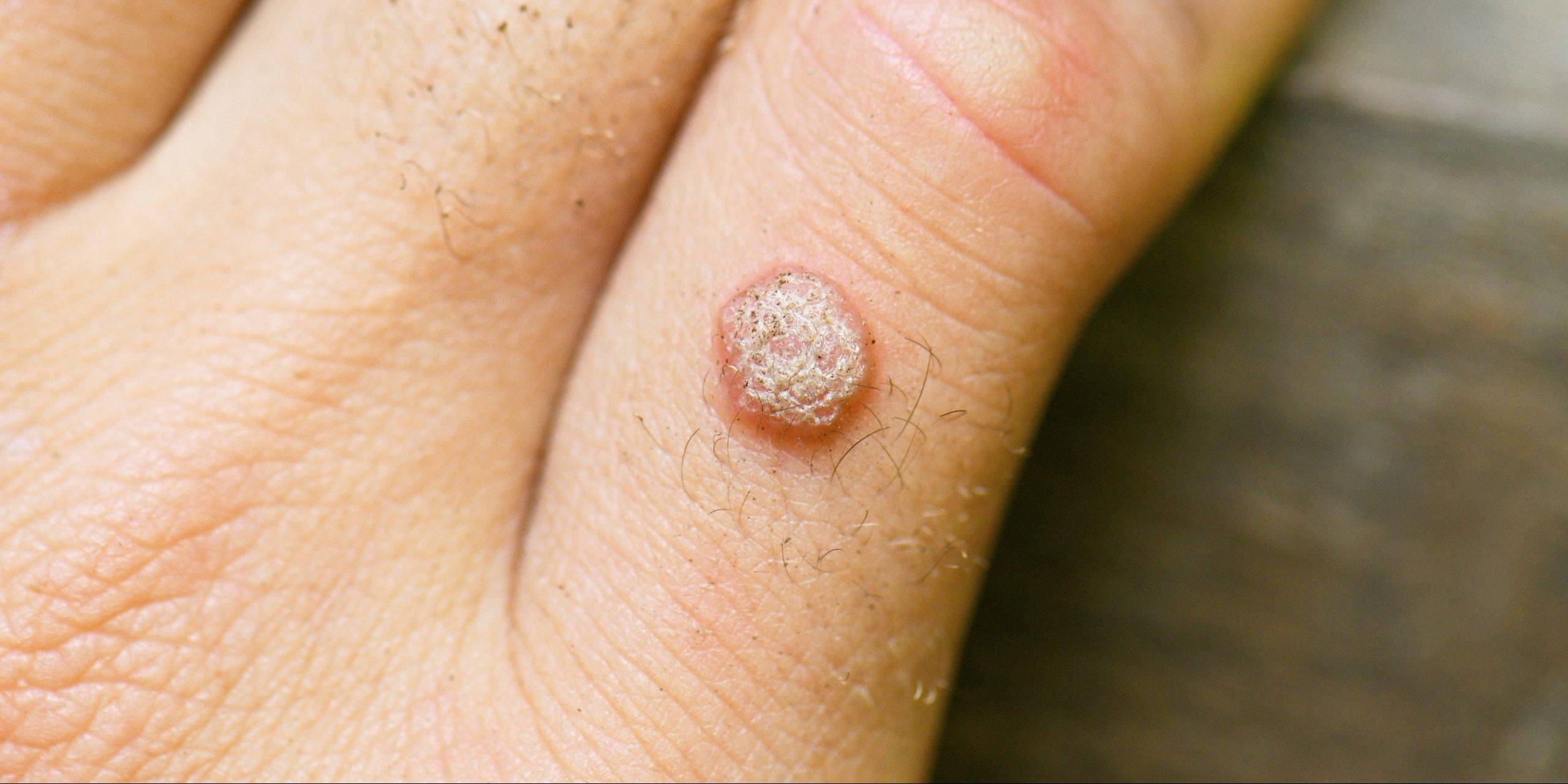 Чому з’являються бородавки на руках: причини та профілактика