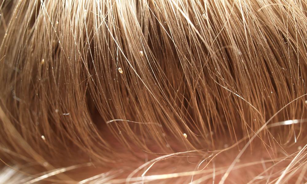 Де беруться воші: шляхи зараження та приховані пастки