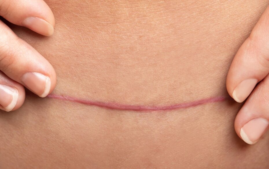 Скільки часу заживає шов після операції: детальний гід по відновленню