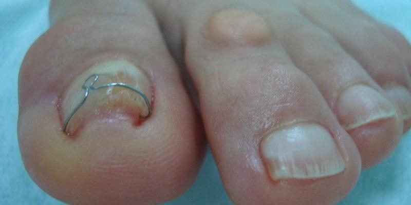 Чому вростають нігті на ногах: причини, що ховаються за болем